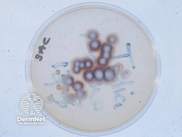 The dermatophyte T.rubrum growing on Sabouraud fungal culture medium