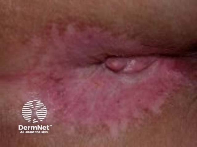 Perianal lichen sclerosus