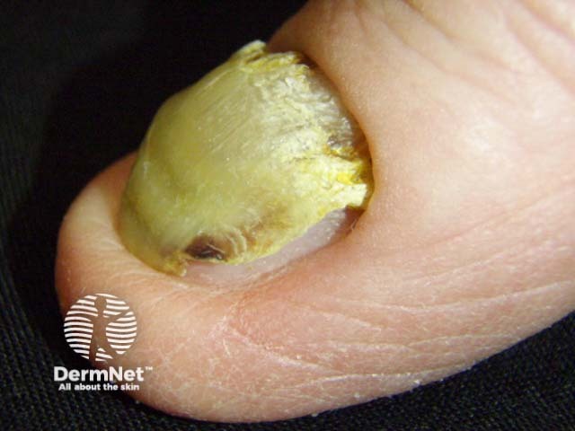 Yellow nail syndrome