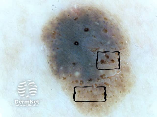 Dermatoscopy of seborrhoeic keratosis. Rectangles highlight comedones