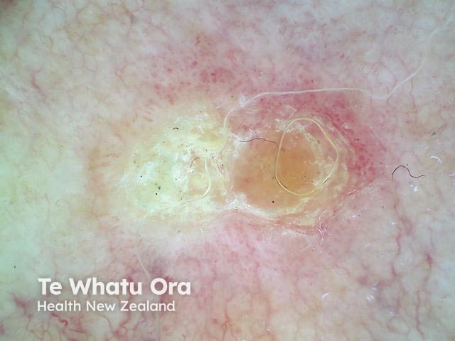 Intraepidermal carcinoma, polarised dermoscopy view