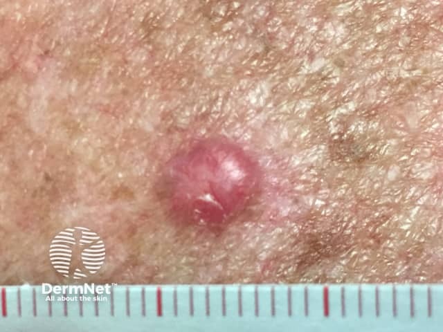 Basal cell carcinoma affecting the trunk