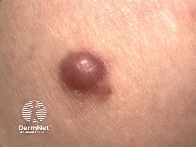 Amelanotic nodular melanoma