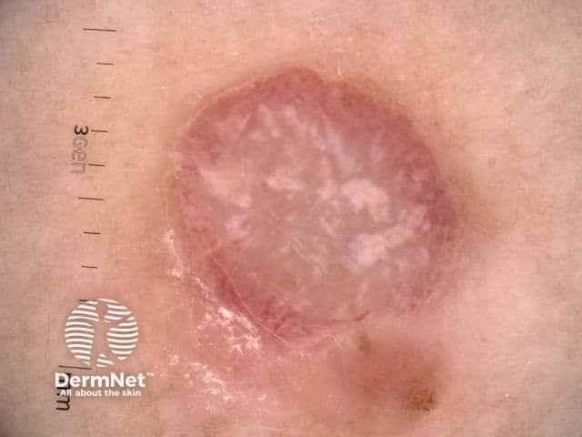 Nodular melanoma