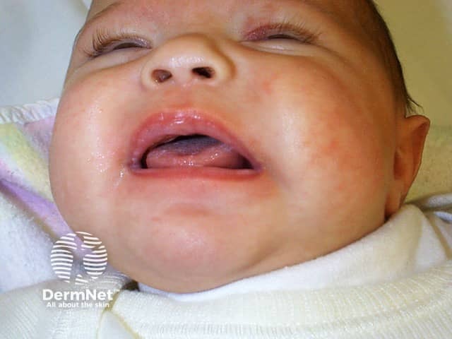 Infantile oral thrush