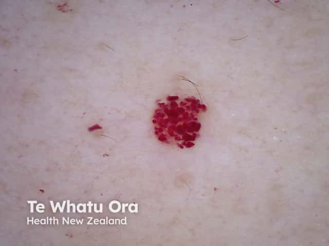 Cherry angioma 6 dermoscopic