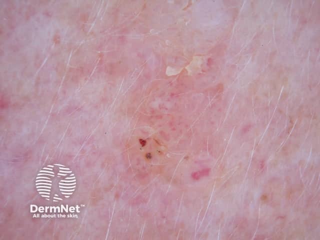 Seborrhoeic keratosis