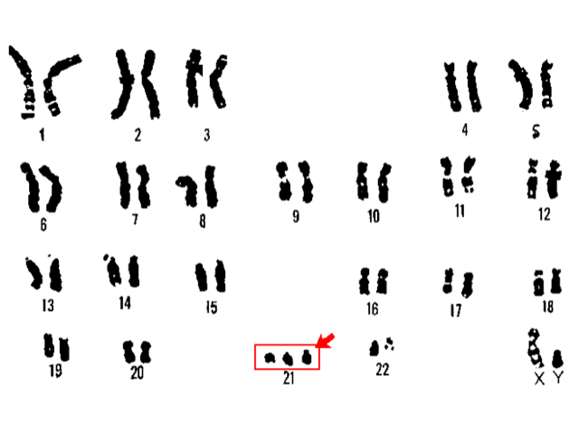 21 trisomy Down syndrome