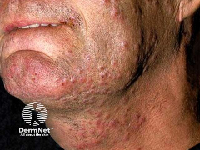 Herpes simplex