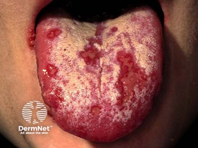 Herpes simplex