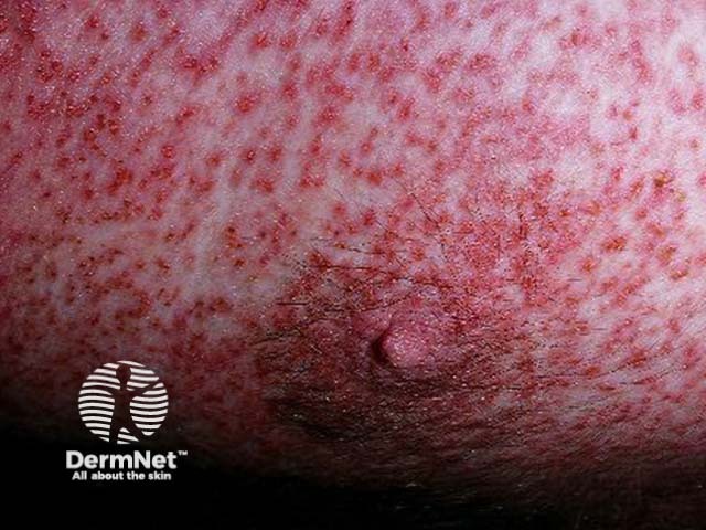 Herpes simplex