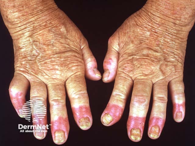 Acrodermatitis continua of Hallopeau