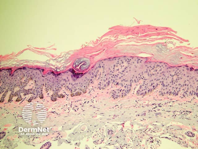 Pathology of actinic keratosis