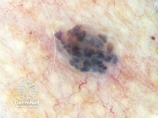 Cherry angioma dermoscopy