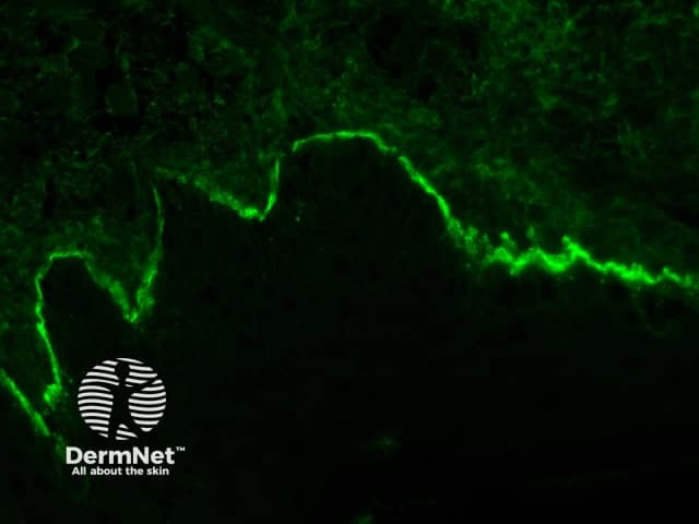 Direct immune fluoroescence