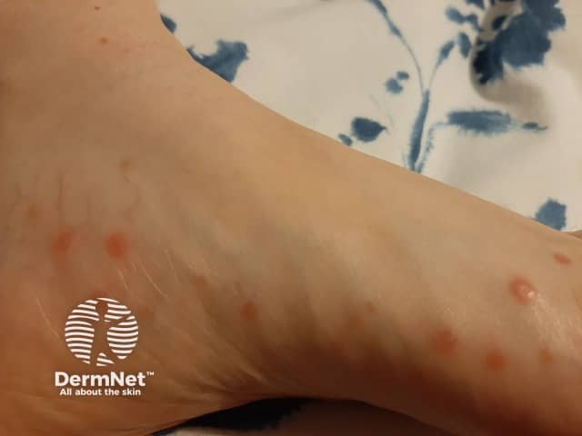 Rash on feet associated with COVID-19