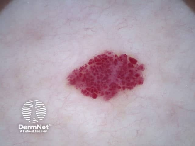 Cherry angioma dermoscopy