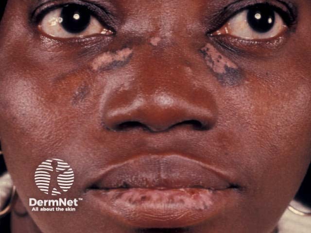 Discoid lupus erythematosus causing hypopigmentation and hyperpigmentation