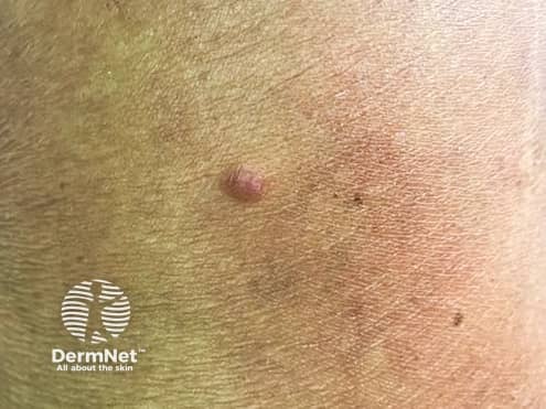 Desmoplastic melanoma