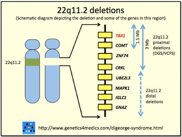 DiGeorge syndrome