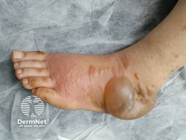 Hand-foot syndrome due to sorafenib