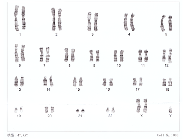 Human chromosomes XXY