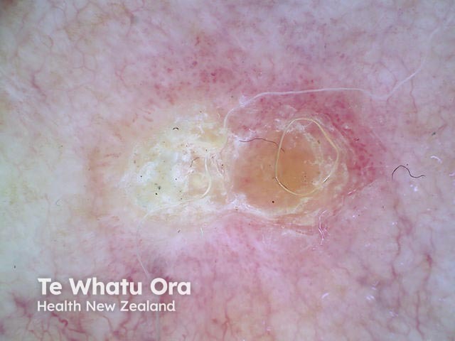 Intraepidermal carcinoma dermoscopy