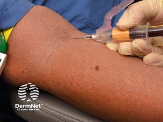 Removing blood for IgE tests