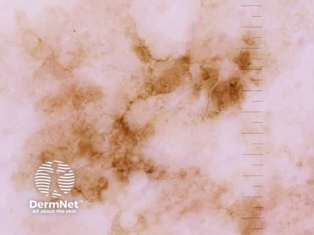 Melanoma in situ 2 dermoscopy