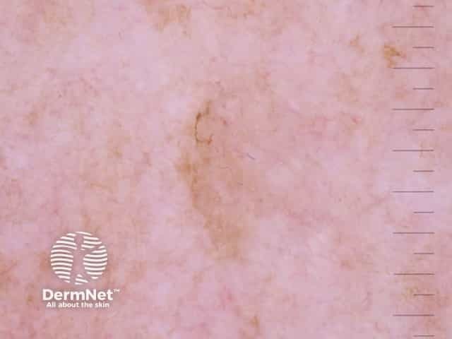 Melanoma in situ 1 dermoscopy