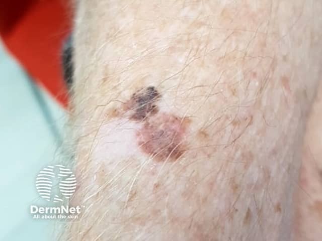 Melanoma-associated leukoderma