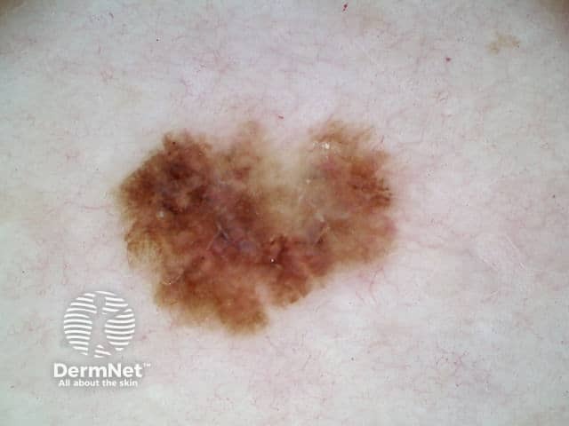 Melanoma in situ 10 dermoscopy