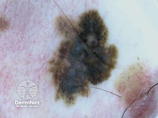 Melanoma in situ 9 dermoscopy