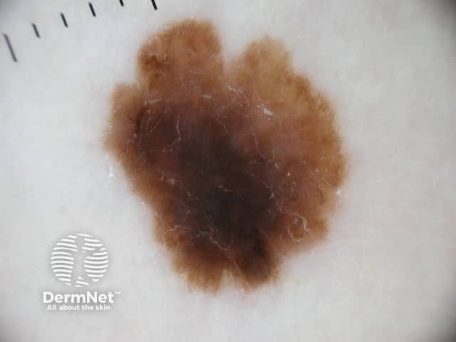 Melanoma in situ 6 dermoscopy