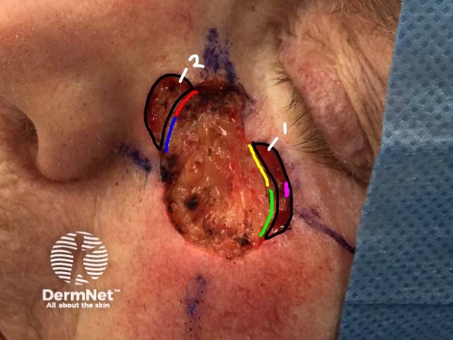 After microscopic examination of histological slides any areas of residual tumor are recognised and