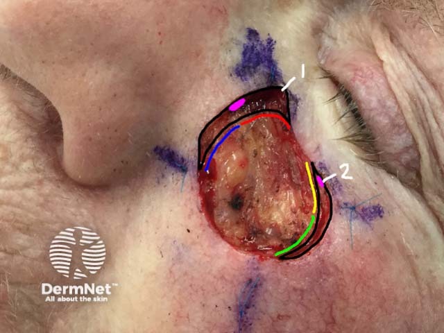 After microscopic examination of histological slides any areas of residual tumor are recognised and