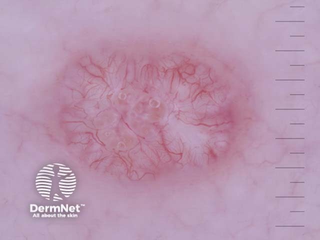 Molluscum contagiosum