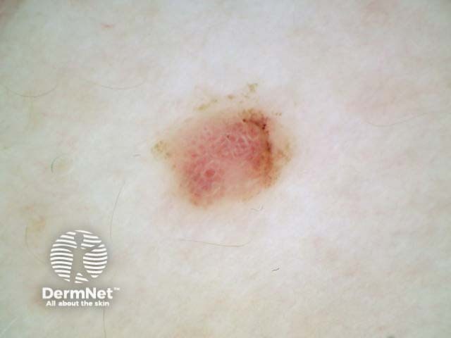 Amelanotic nodular melanoma