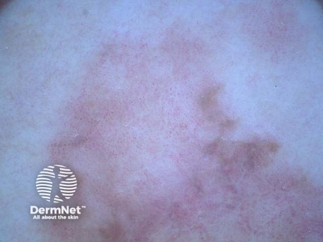 Amelanotic melanoma