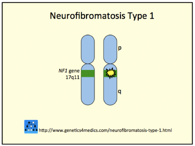 Neurofibromatosis Type 1