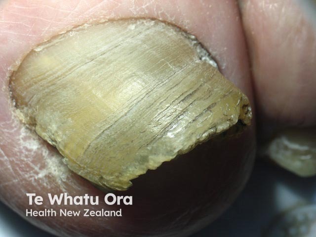 Onychomycosis, toenail