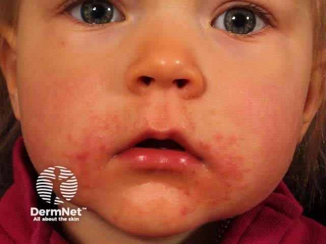 Periorificial dermatitis in a child