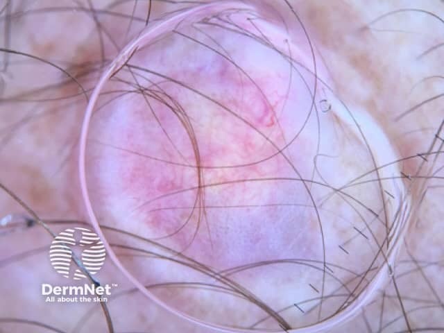 Pilomatricoma dermoscopy