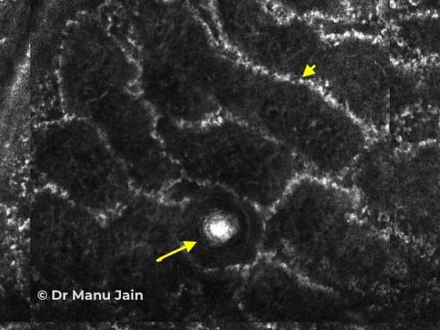 Figure 1. Dermo-epidermal junction