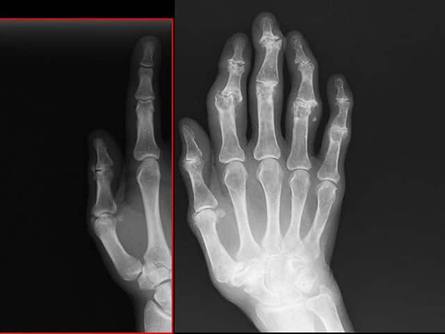 X-ray of Heberden and Bouchard nodes