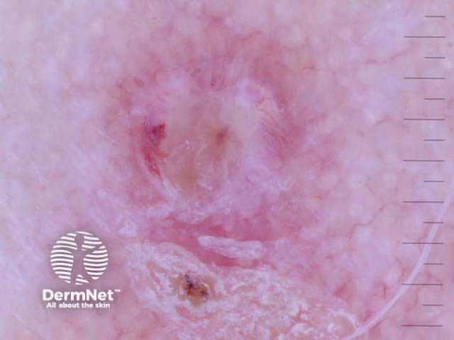 Loop vessels seen in squamous cell carcinoma dermoscopy