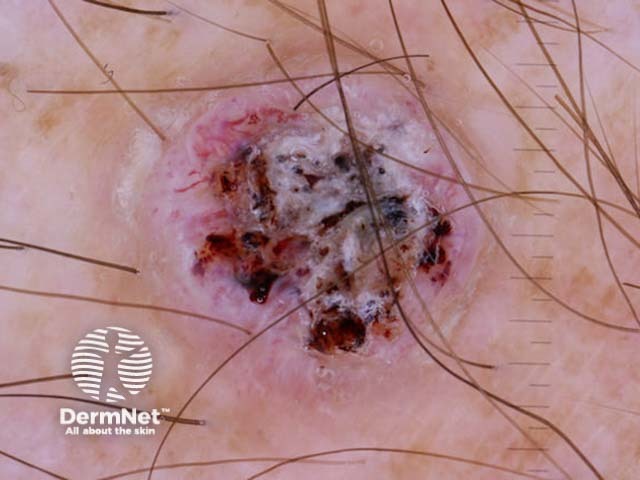 Squamous cell carcinoma, keratoacanthoma type, polarised dermoscopy view