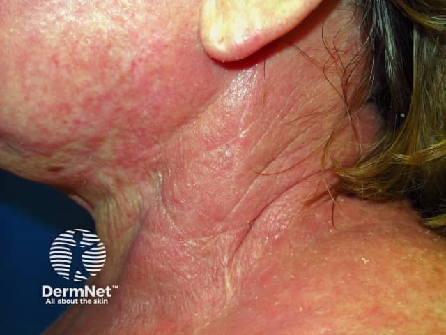 Atopic dermatitis affecting neck