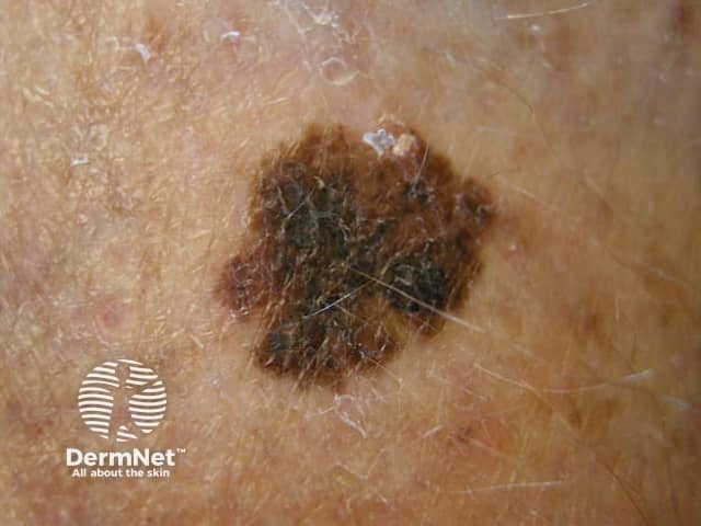 Macro image of superficial spreading melanoma 5