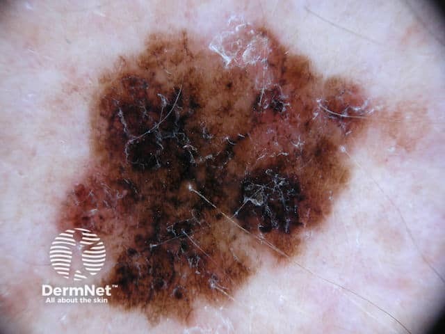 Dermoscopic image of superficial spreading melanoma 5